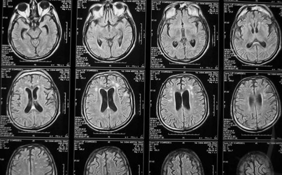 Учёные из Челябинской области применяют нейросеть для поиска опухоли мозга на снимках МРТ